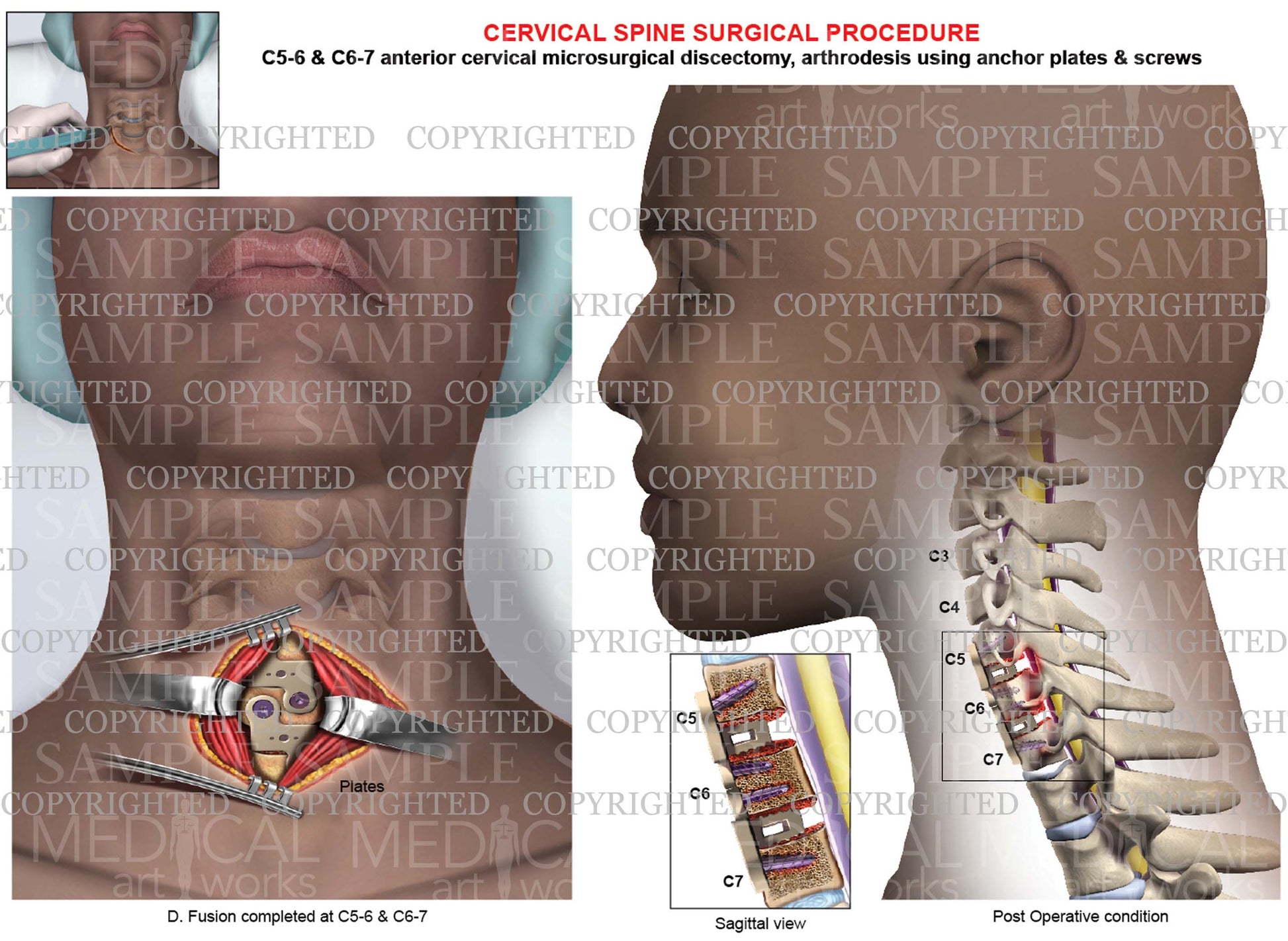 C5 6 C6 7 Post Operative Condition Anterior Cervical Discectomy And c5-6-c6-7-post-operative-condition-anterior-cervical-discectomy-and