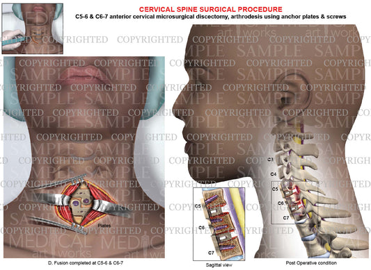 C5-6 - C6-7 Post operative condition Anterior cervical discectomy and fusion  - plate & screws - female