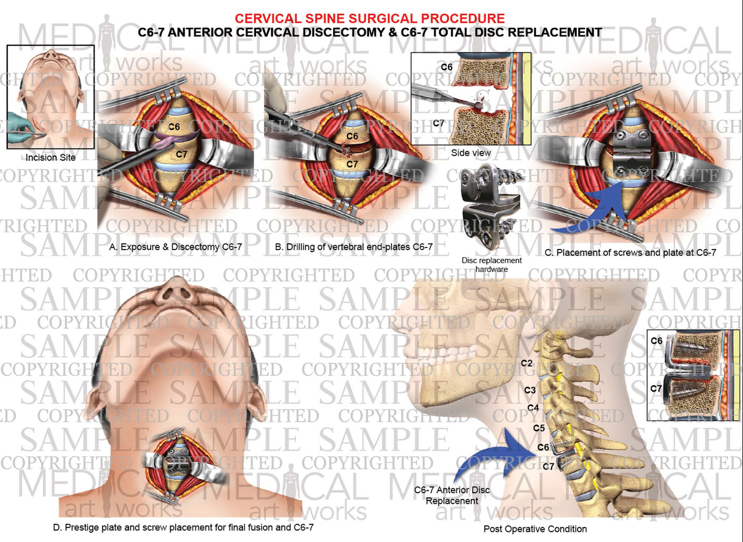 1 Level - C6-C7 anterior cervical discectomy and fusion - cervical artificial disc replacement
