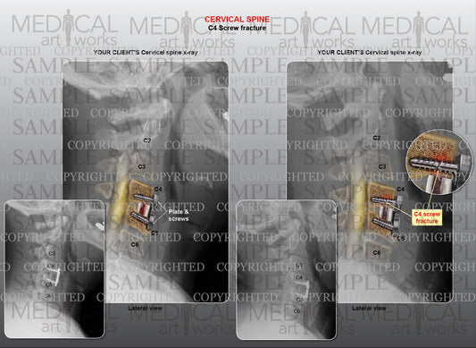 1 level - C4 screw fracture and fusion