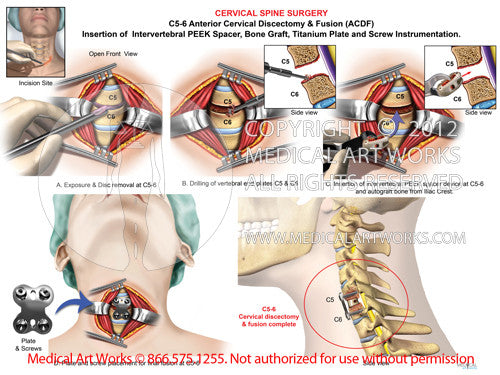 medical Illustration- C5-6 Anterior cervical discectomy and fusion ACDF