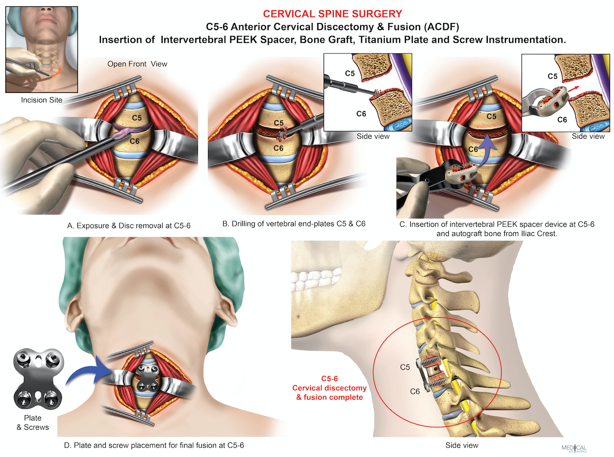 1 level - C5-6 Anterior cervical discectomy and fusion ACDF