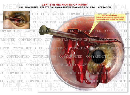 Traumatic Eye Injury - A nail ruptures globe and lacerates sclera