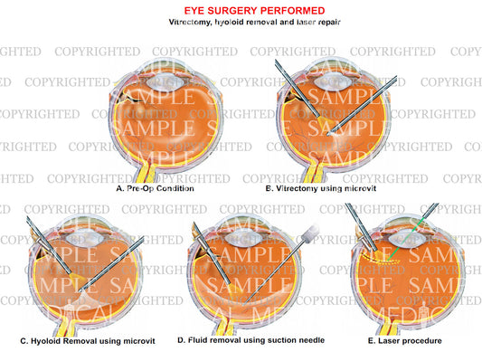 Eye surgery - Vitrectomy, hyoloid removal and laser repair