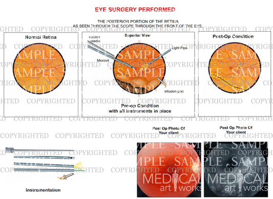 Eye surgery - View through scope