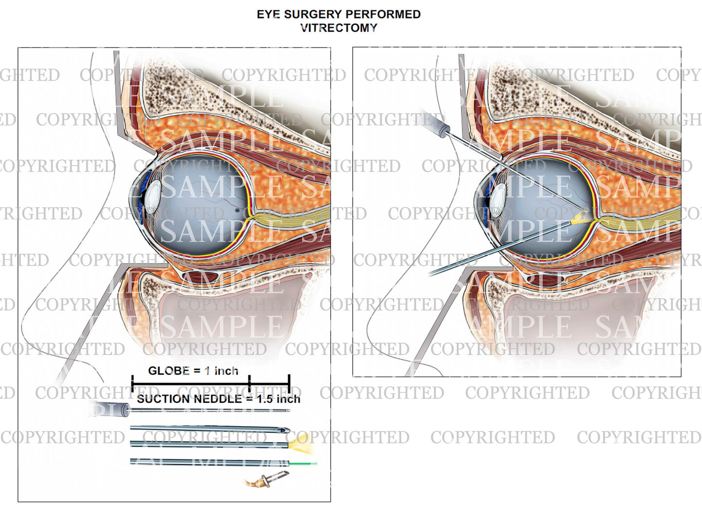 Eye surgery - Vitrectomy