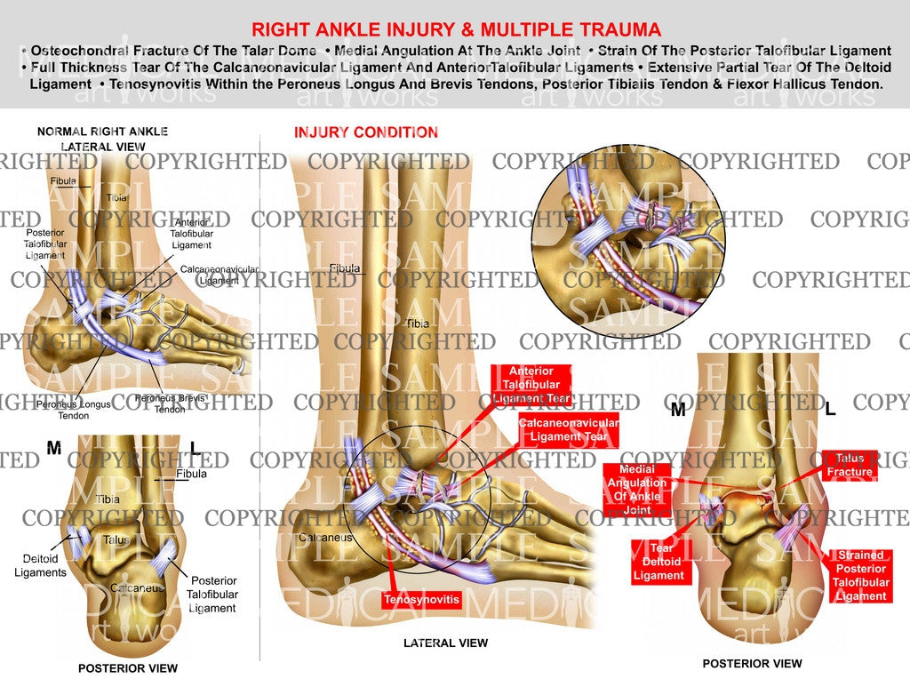Right foot osteochondral & ligament injury