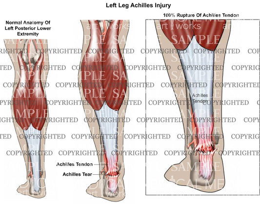 Left achilles rupture