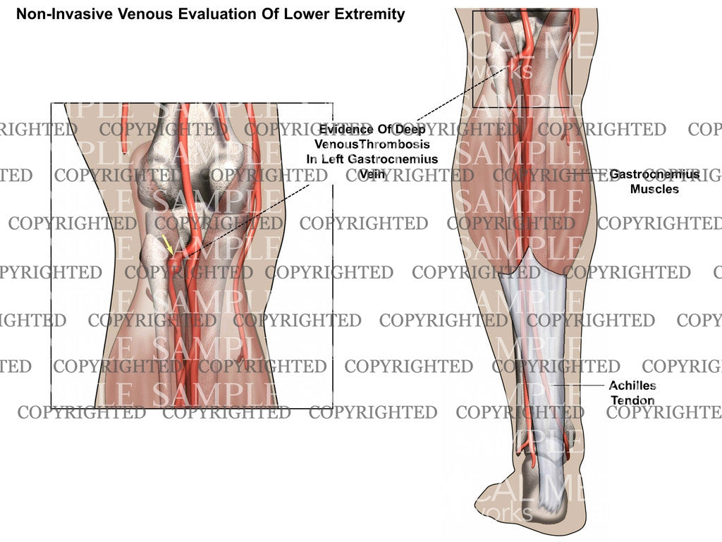 Non-Invasive venous evaluation of lower extremity