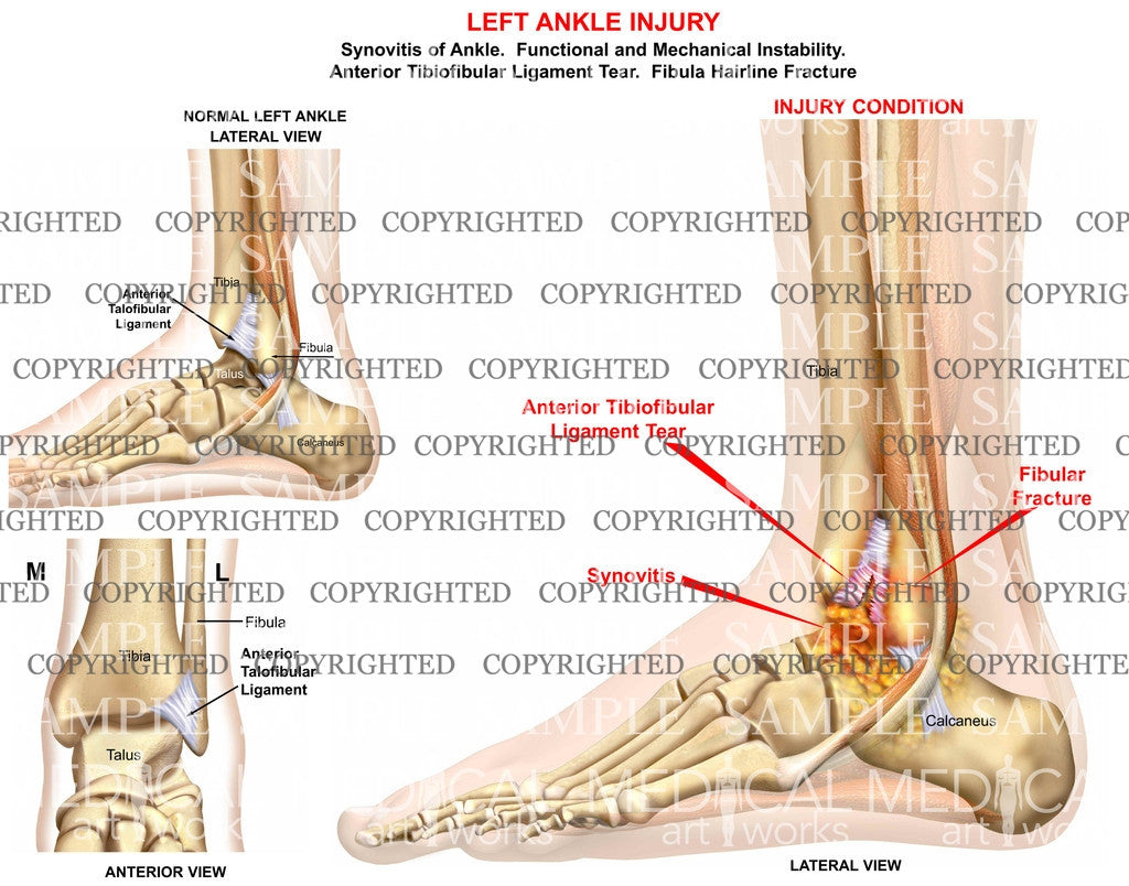 Left ankle ligament tear and synovitis