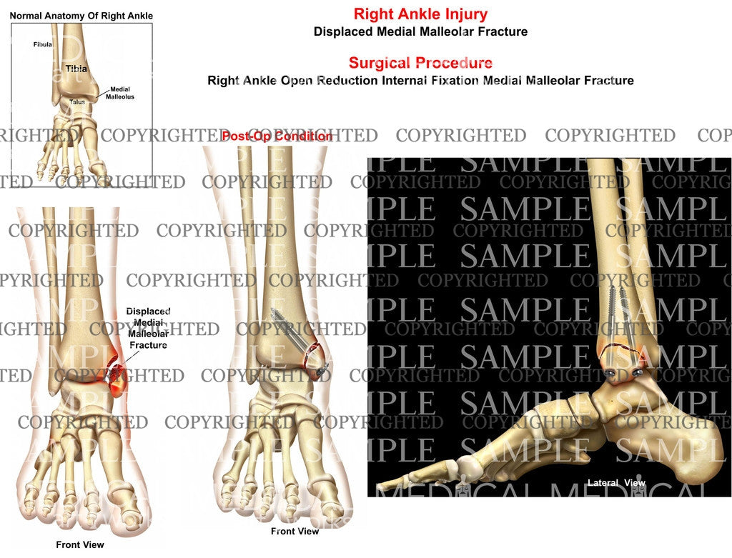 Right medial malleolus fracture displacement - ORIF