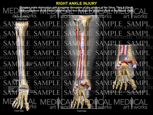 Right complex ankle ligament disruption