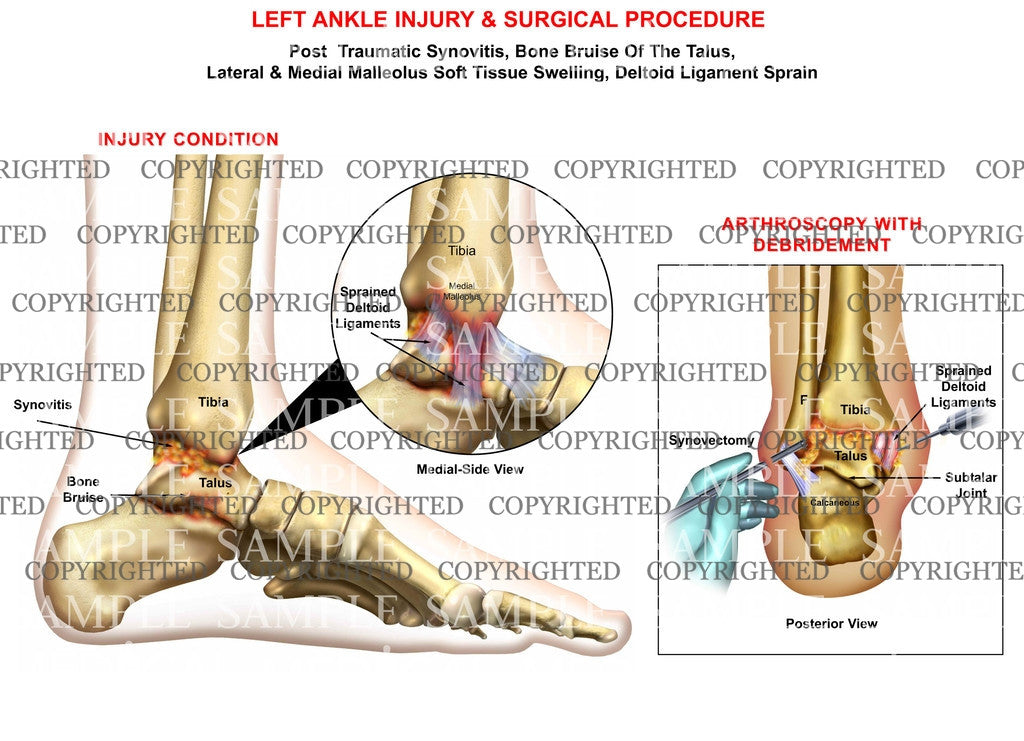 Left ankle sprain+synovitis & arthroscopy