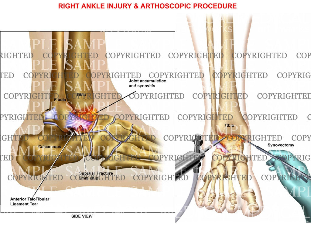 Right Ankle Injury & Arthoscopic Procedure