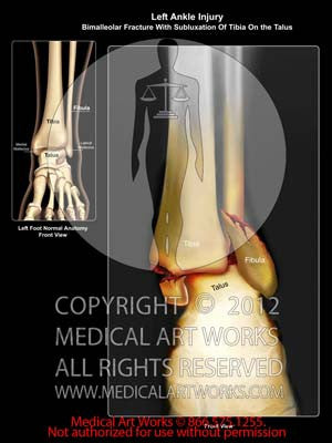 Left Ankle Bimalleolar Fracture With Subluxation
