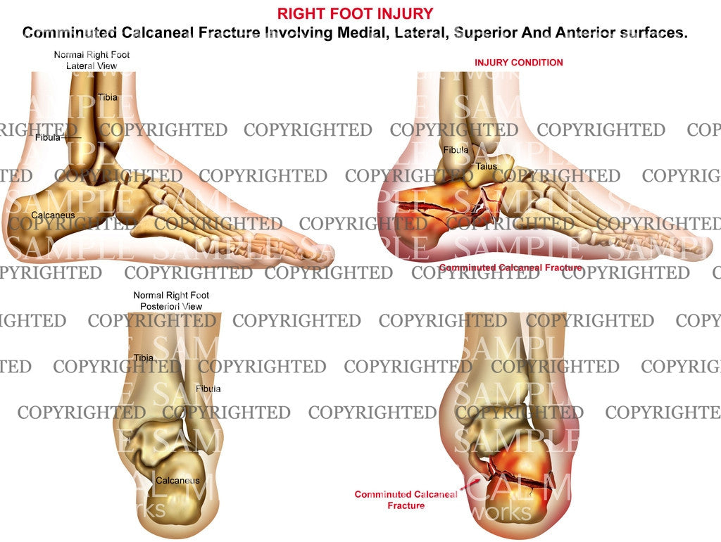 Right comminuted calcaneal fracture