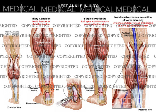 Achilles tendon tear & deep vein thrombosis