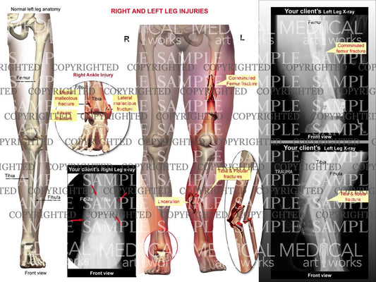 Right and Left leg injuries