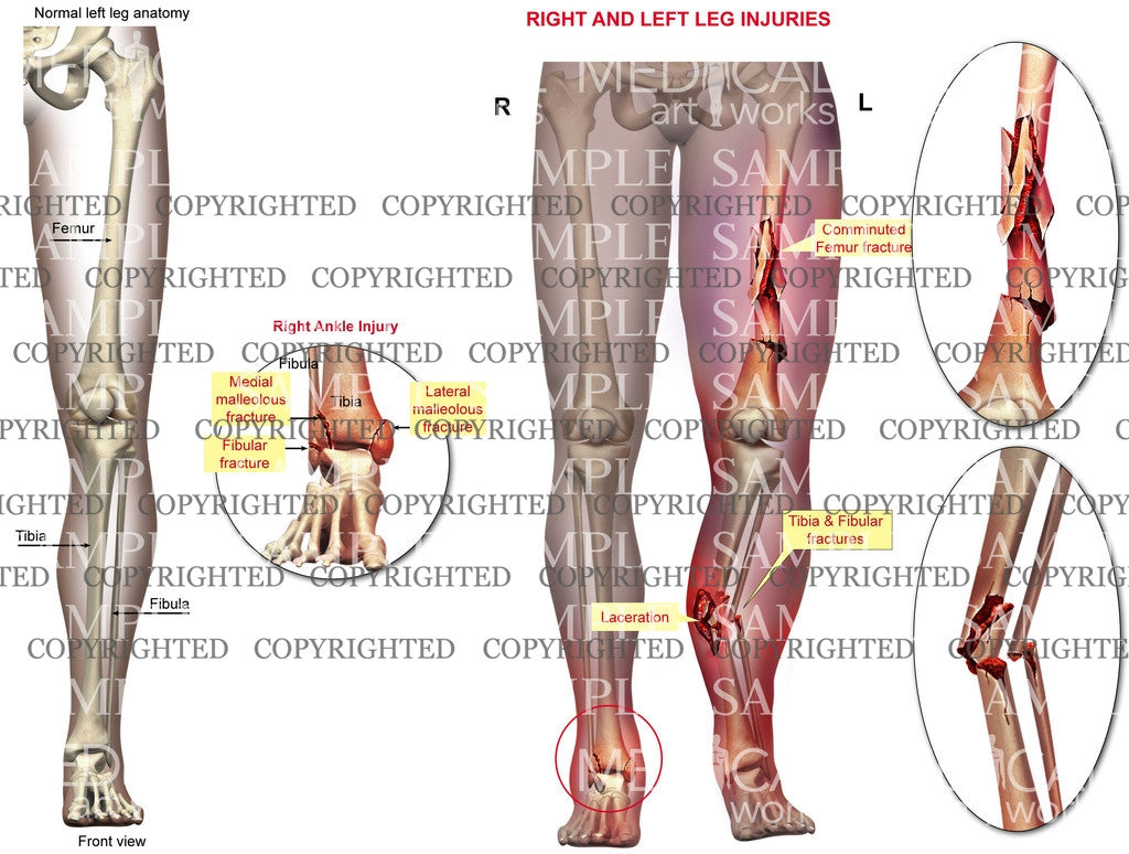 Right and Left multiple skeletal fractures