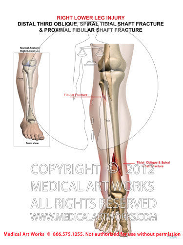 Fracture of the proximal fibula and tibia - Right Lower leg
