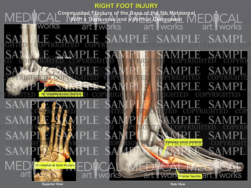 Right foot 5th metatarsal fracture
