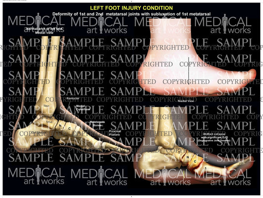 Left midfoot Lisfranc-Type fracture