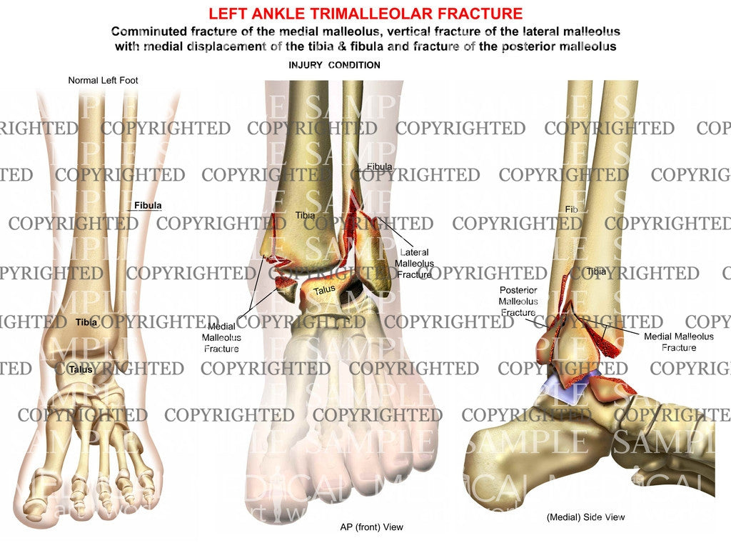 Left Ankle trimalleolar Fracture