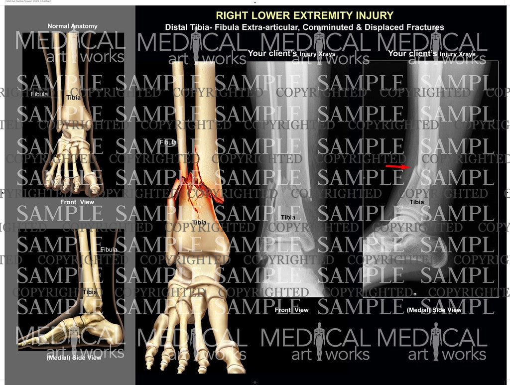 Right Tib-Fib shaft comminuted fractures – Medical Art Works