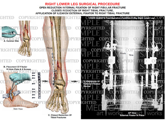 Right fibular fracture - ORIF- External fixator