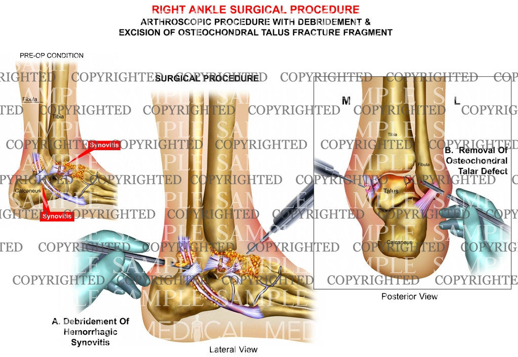 Right ankle arthroscopic debridement