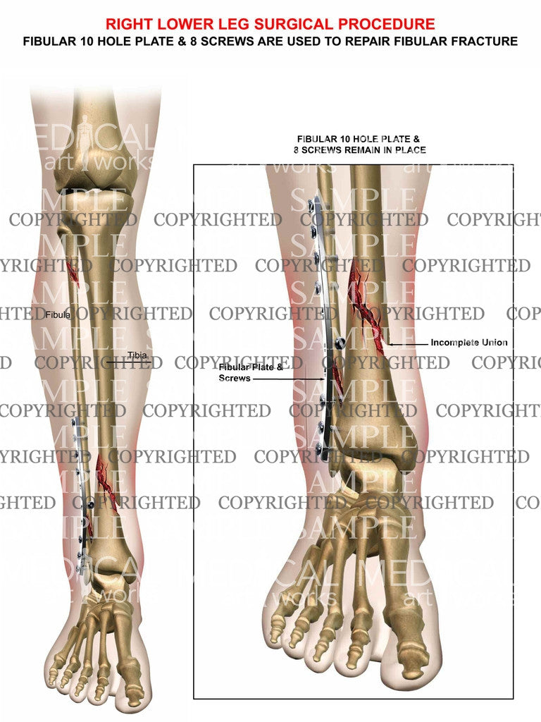 Fibula/Tibia  fractures & Plate fixation
