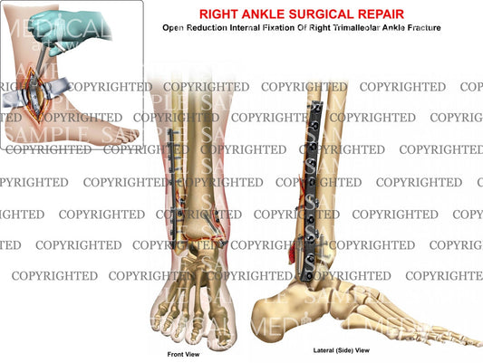 Trimalleolar ankle fracture & plate ORIF