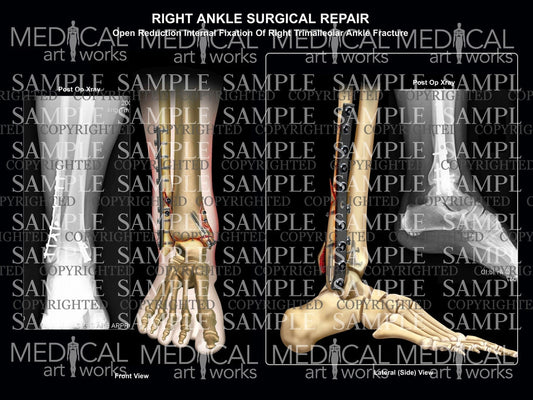 Trimalleolar Tib-Fib fractures & plate ORIF