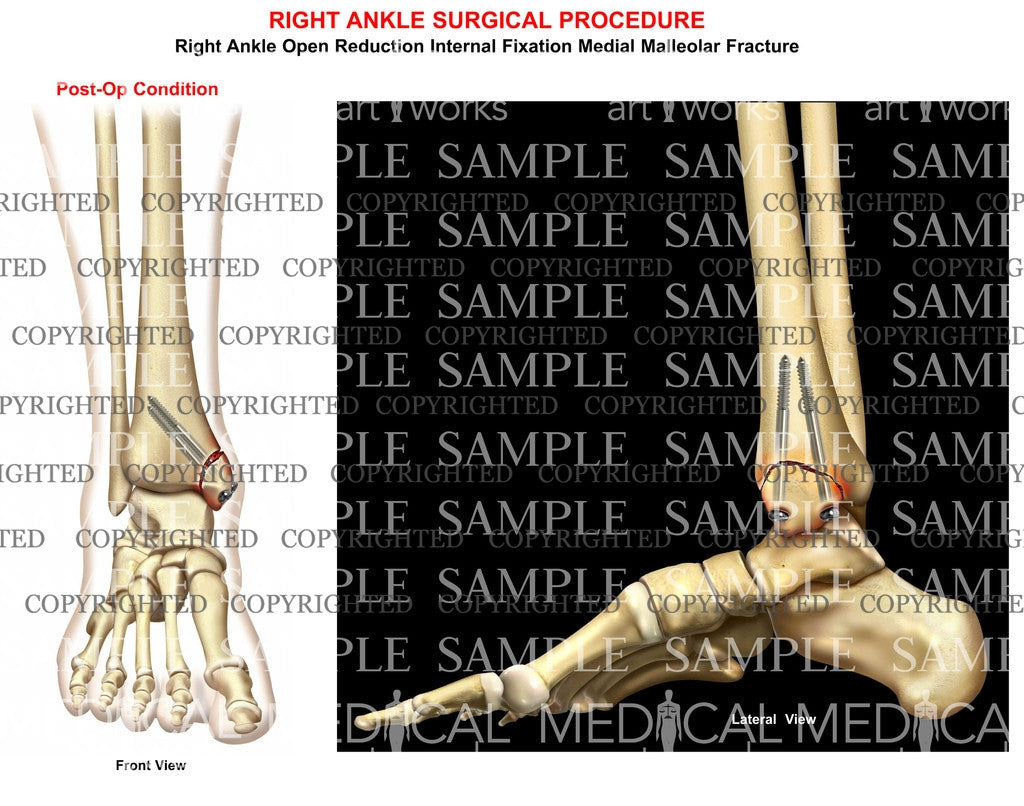 ORIF of medial malleolus tibial fracture