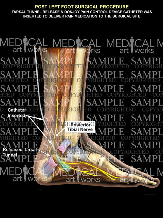 Tarsal tunnel release & Donjoy pump2