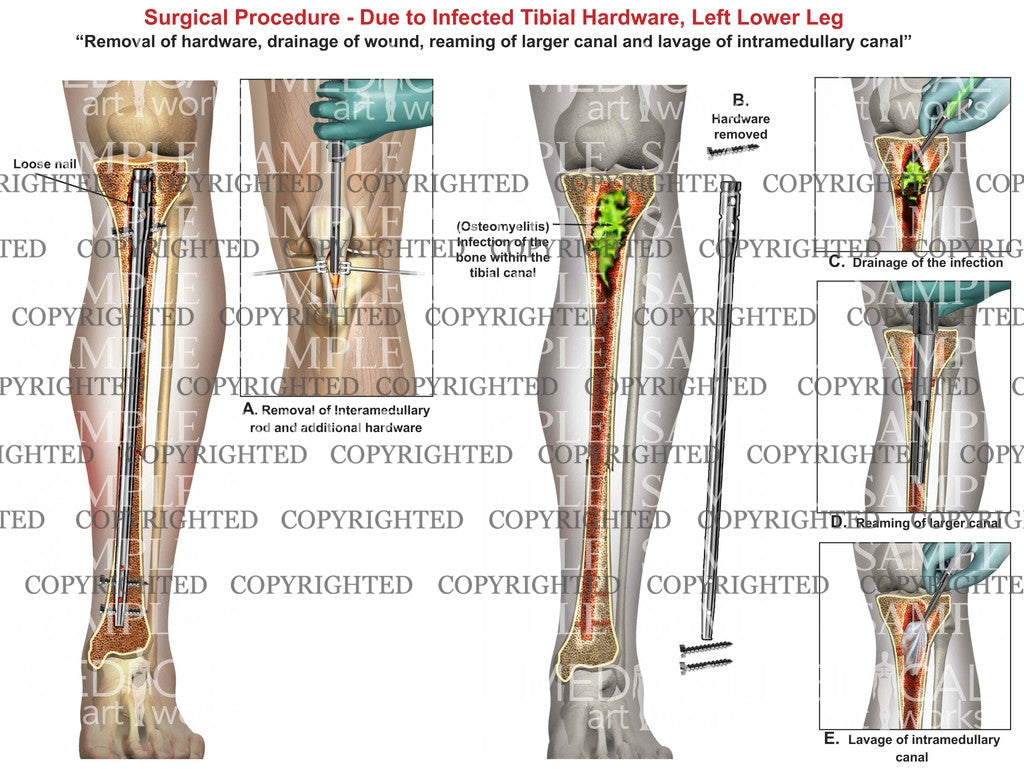 Right tibia intramedullary canal lavage