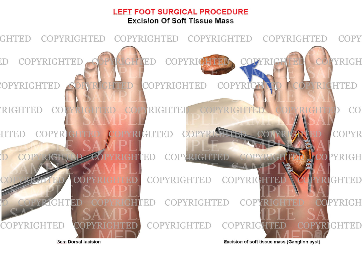 Surgical excision of left foot ganglion cyst