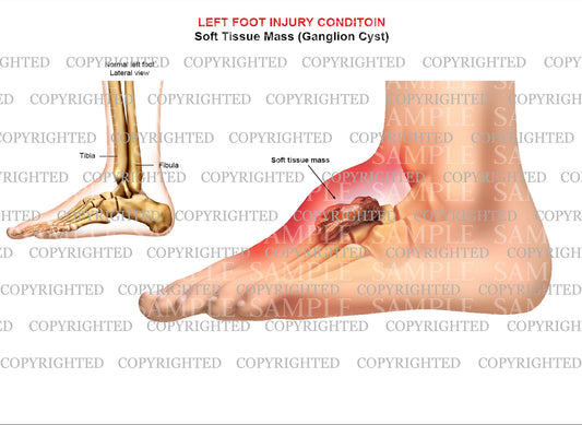 Left foot ganglion cyst