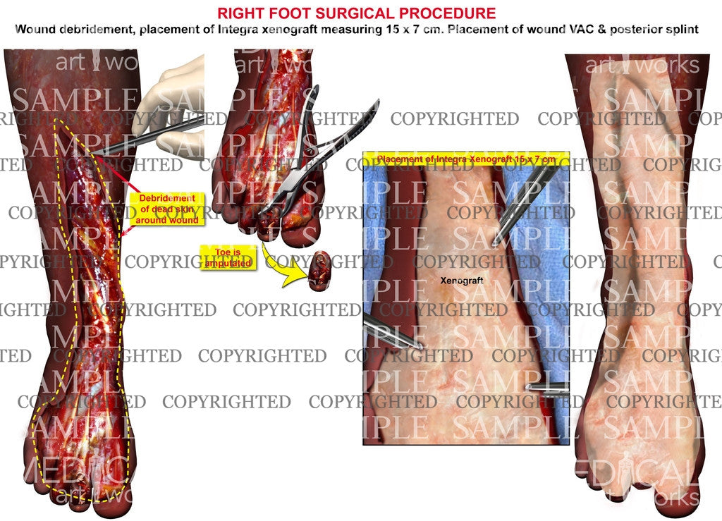Foot wound debridement and xenograft