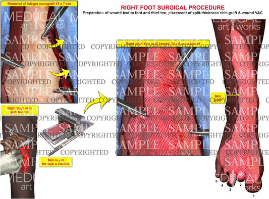 Right foot integra removal and placement of skin graft