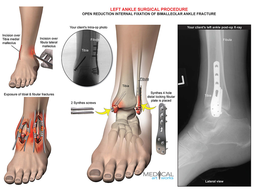 Left ankle and tibia bimalleolar fracture ORIF Medical Art Works