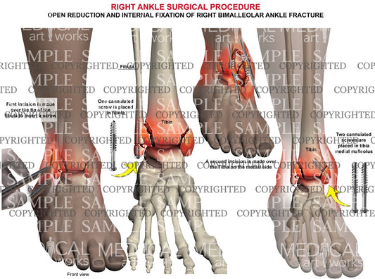 Right bimalleolar fracture & screw fixation