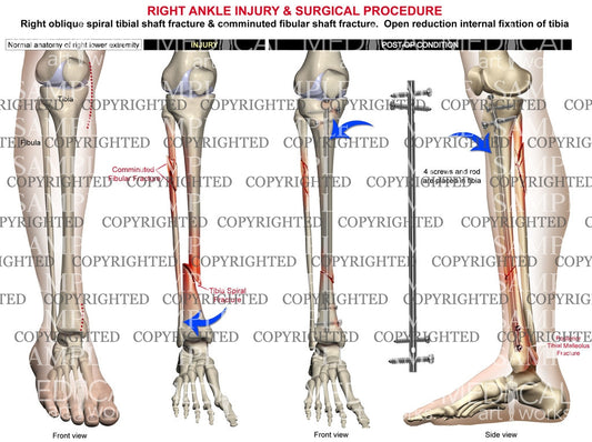 Right oblique tibial fracture & rod fixation