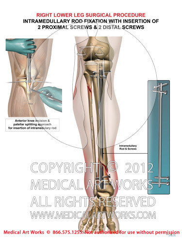 Tibial intramedullary rod fixation surgery