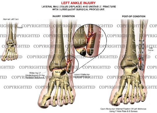 Left ankle lateral malleolus fracture & plate fixation
