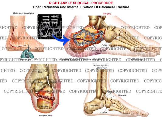 Right calcaneal fracture & plate fixation - ORIF