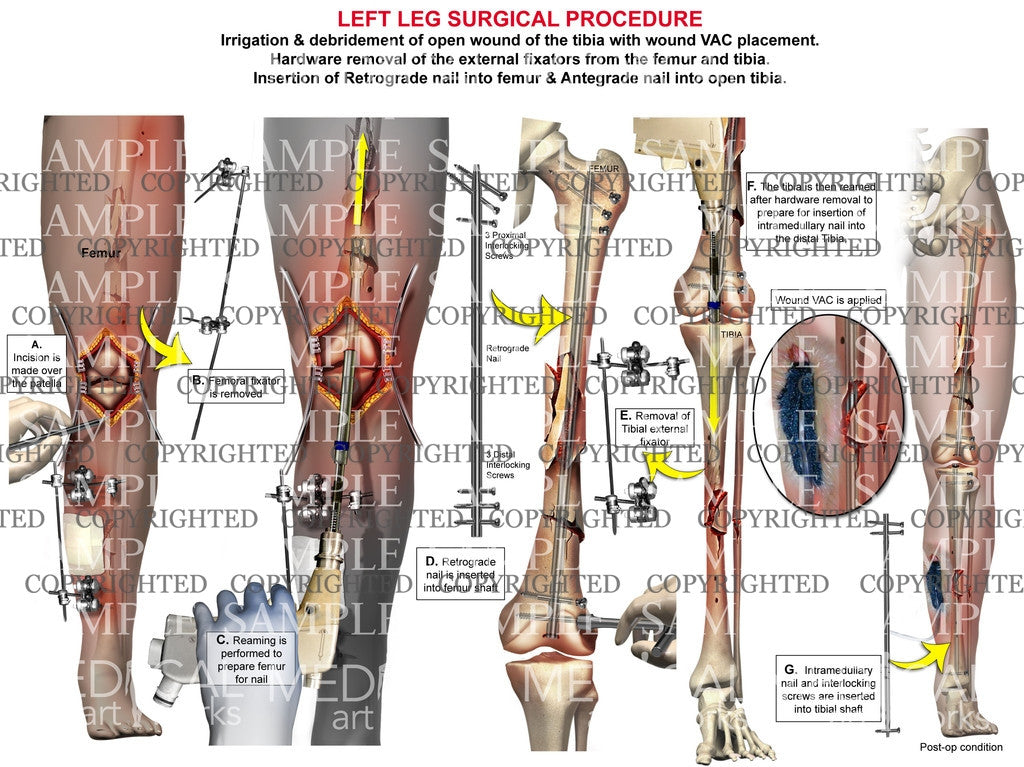 Lower extremity multiple wound, hardware procedures