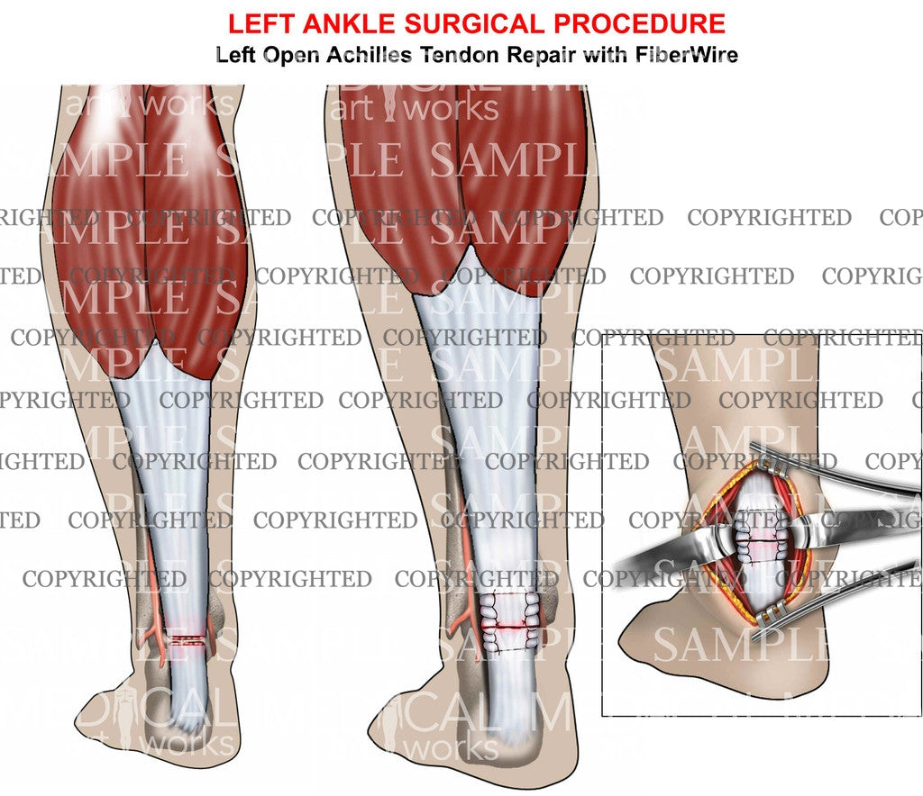 Achilles tendon tear & repair