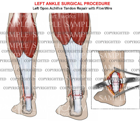 Achilles tendon tear & repair