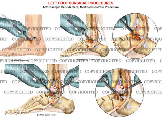 Left foot arthroscopic synovectomy